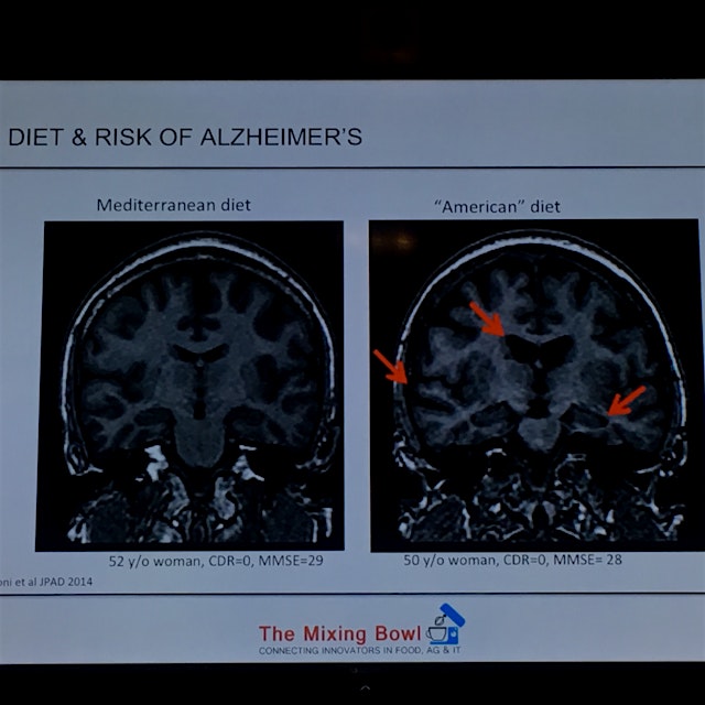 The more water you have in your brain the less tissue you have. American diet brain has way more ...